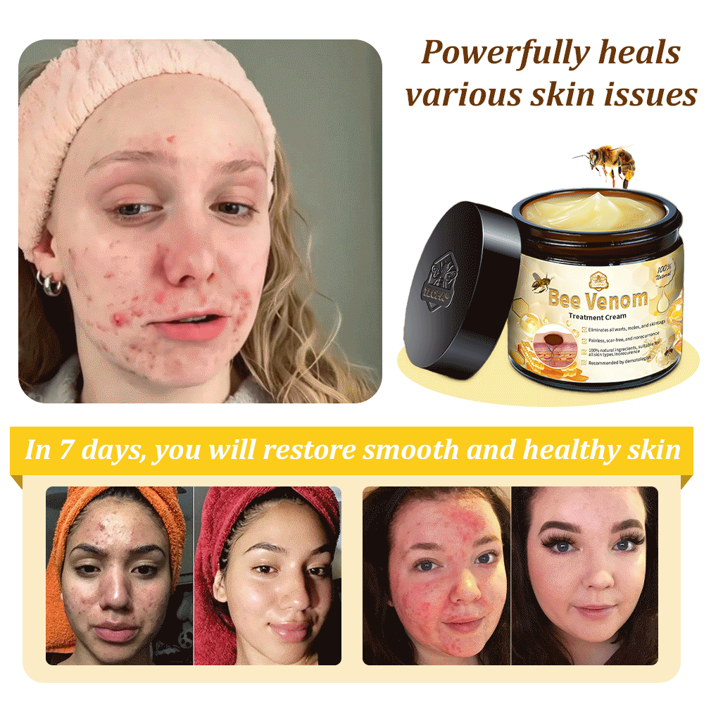 Official Store: TLOPA® Bee Venom Skin Treatment Cream👨⚕️British Association of Dermatologists (BAD) Approved🌻