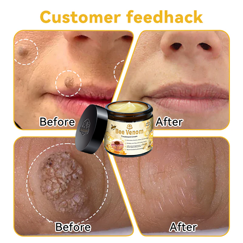 Official Store: TLOPA® Bee Venom Skin Treatment Cream👨⚕️British Association of Dermatologists (BAD) Approved🌻