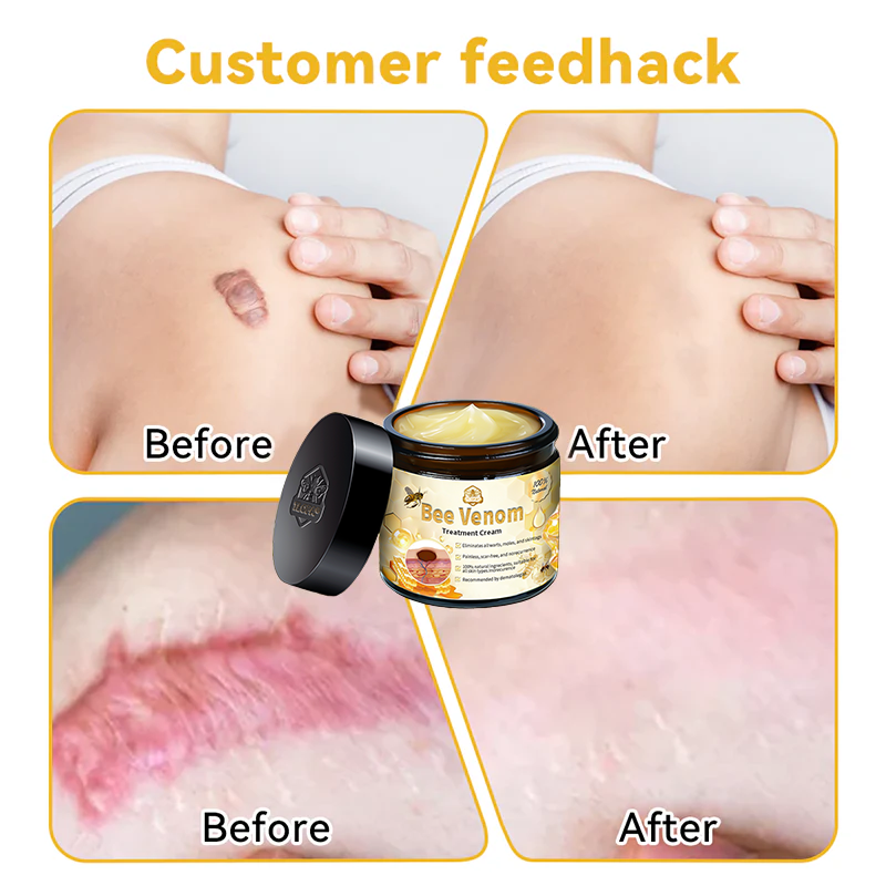 Official Store: TLOPA® Bee Venom Skin Treatment Cream👨⚕️British Association of Dermatologists (BAD) Approved🌻